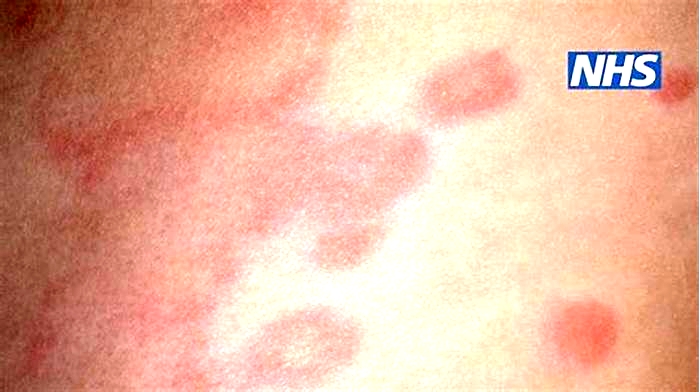 Are hives contagious by touch?