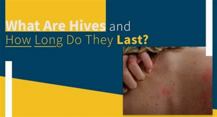 Can hives go away in 2 days?