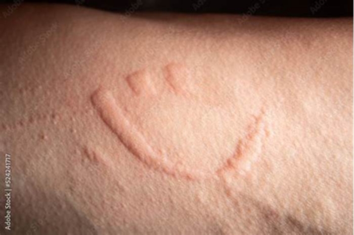 Can hives spread by scratching