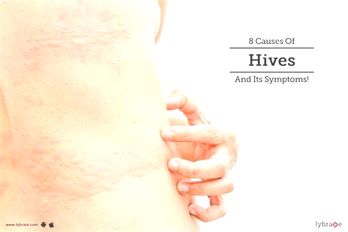 Can lack of sleep cause hives?