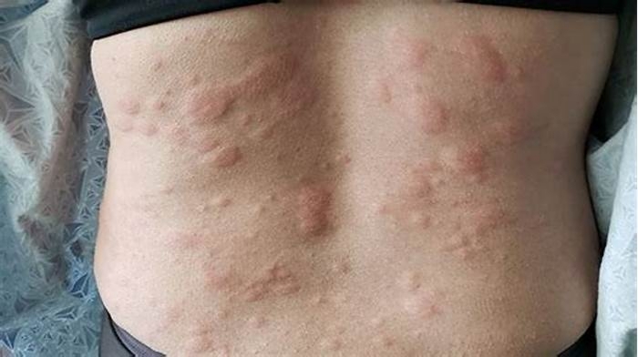 Can scratching skin cause hives