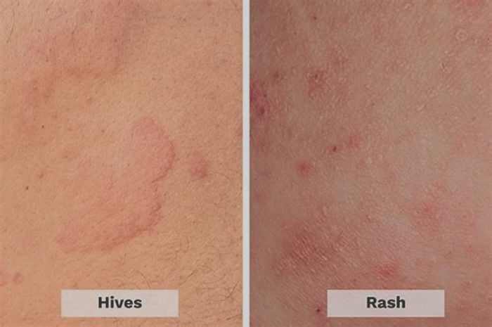 Do hives get worse before they get better?