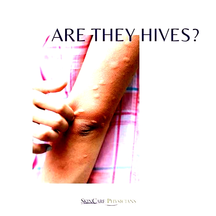 Do hives get worse when you touch them