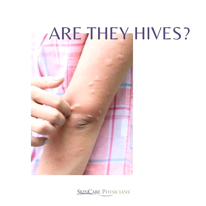 Do hives spread by touch