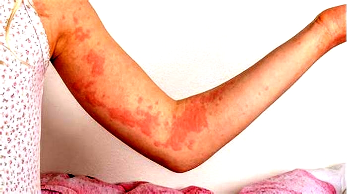 Does eating make hives worse