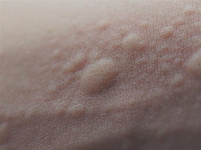 Does hives go away on its own?