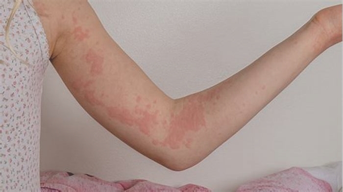 Does scratching make hives worse