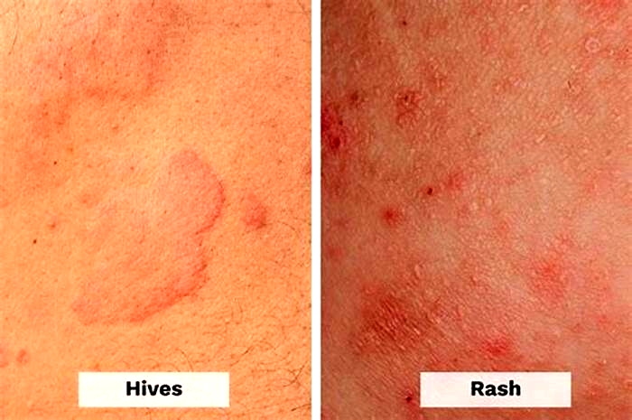 Does touching hives make them worse?