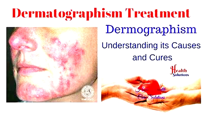 How I cured my dermatographia?