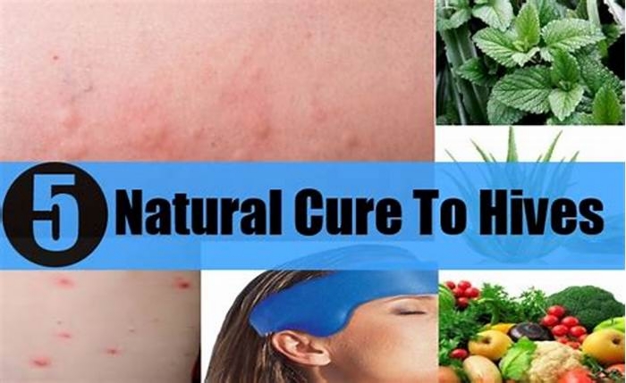 How I cured my hives naturally