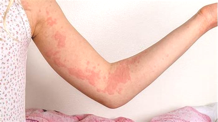 How do I know if my hives are autoimmune?