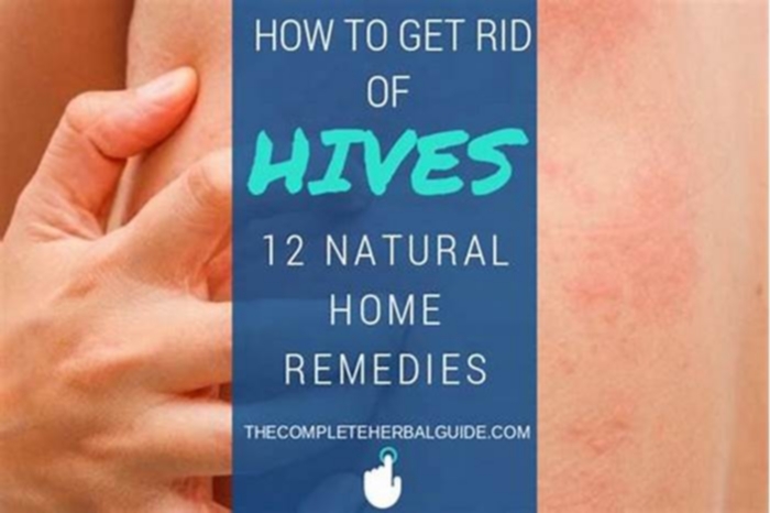 How do you get hives to go away?