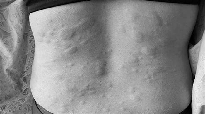 How do you sleep with itchy hives?