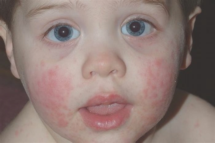 How do you tell if a rash is an allergic reaction