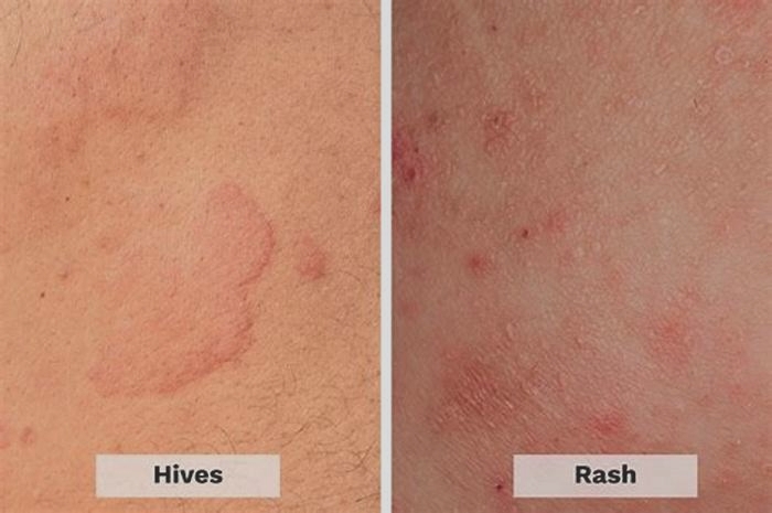 How do you tell if hives are from stress or allergy?