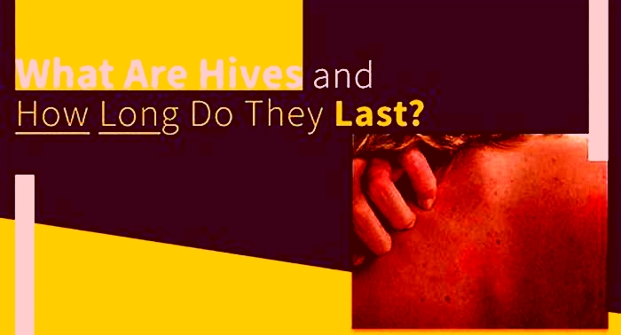 How long do hives usually last?