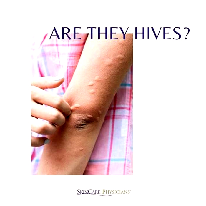 How long is it OK to have hives?