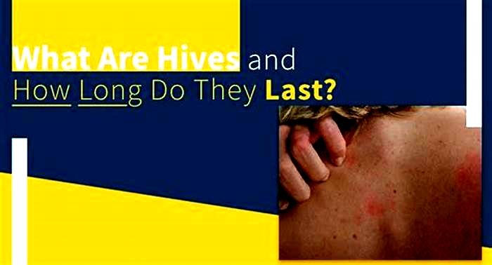 How long is too long for hives to last?