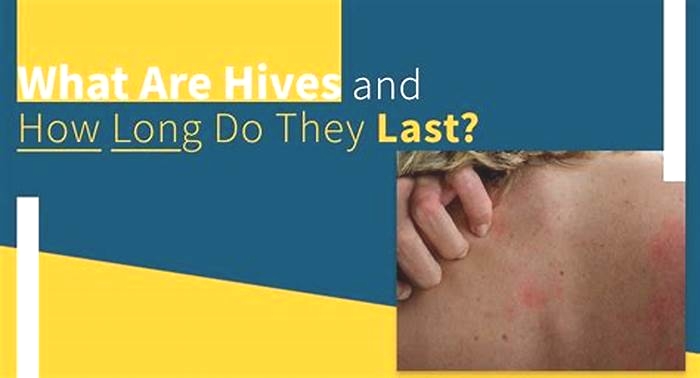 How long is too long for hives?