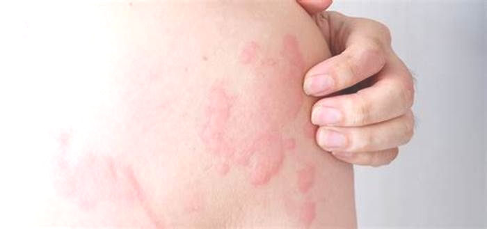 How long will I have hives after an allergic reaction?