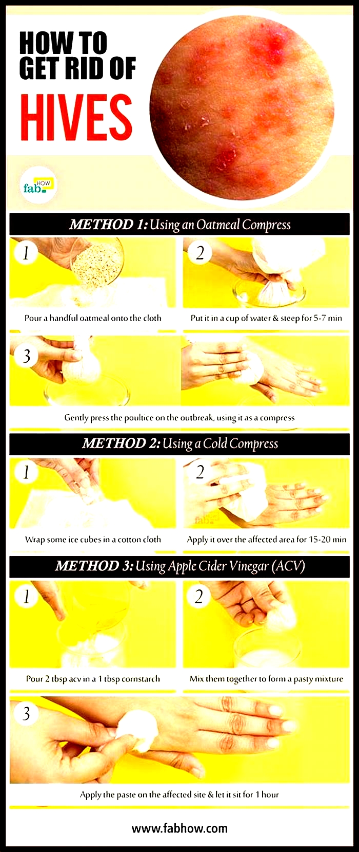 How to calm down hives?