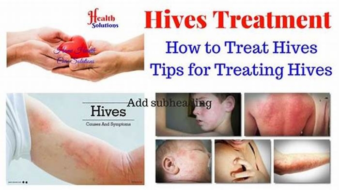 How to flush hives out of your system