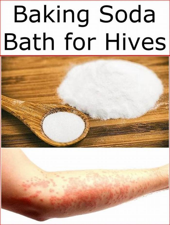 Is a bath good for hives