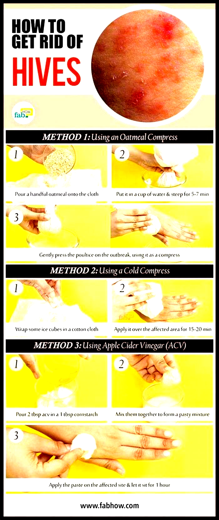 Is it bad to moisturize hives?