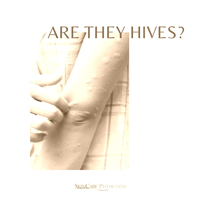 Is it okay to leave hives untreated