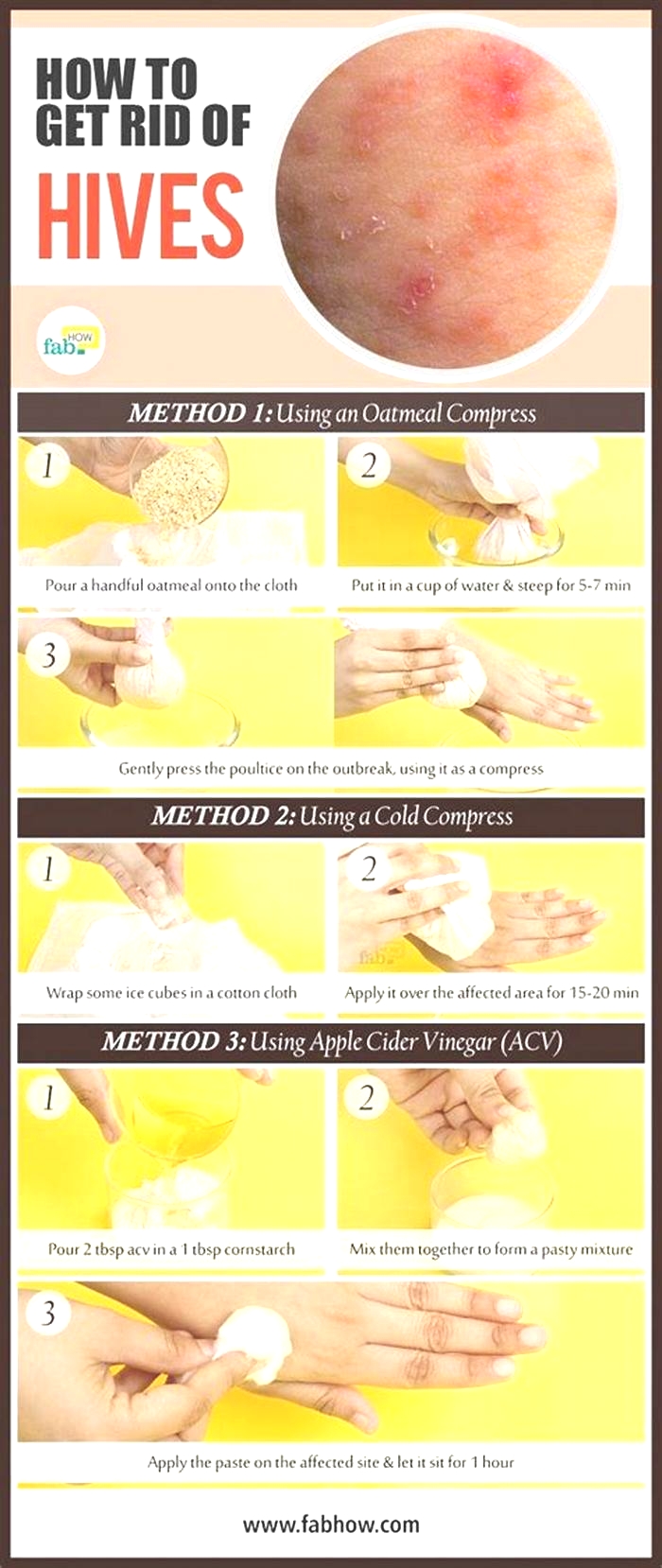 Should you moisturize hives