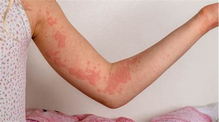 What do autoimmune hives look like?