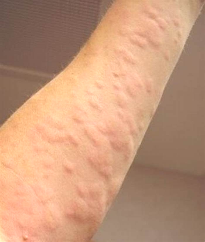 What do hives look like?