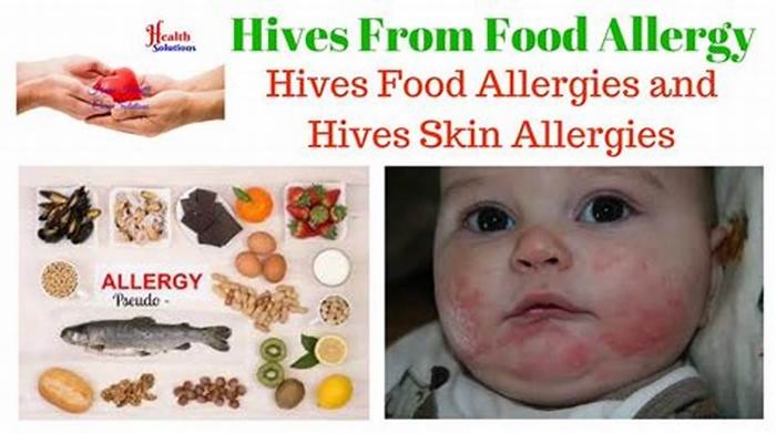 What foods make hives worse?