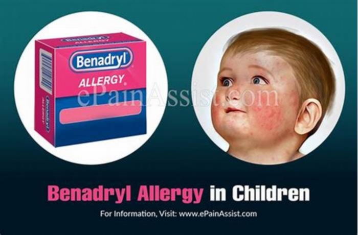 What if hives get worse after Benadryl?