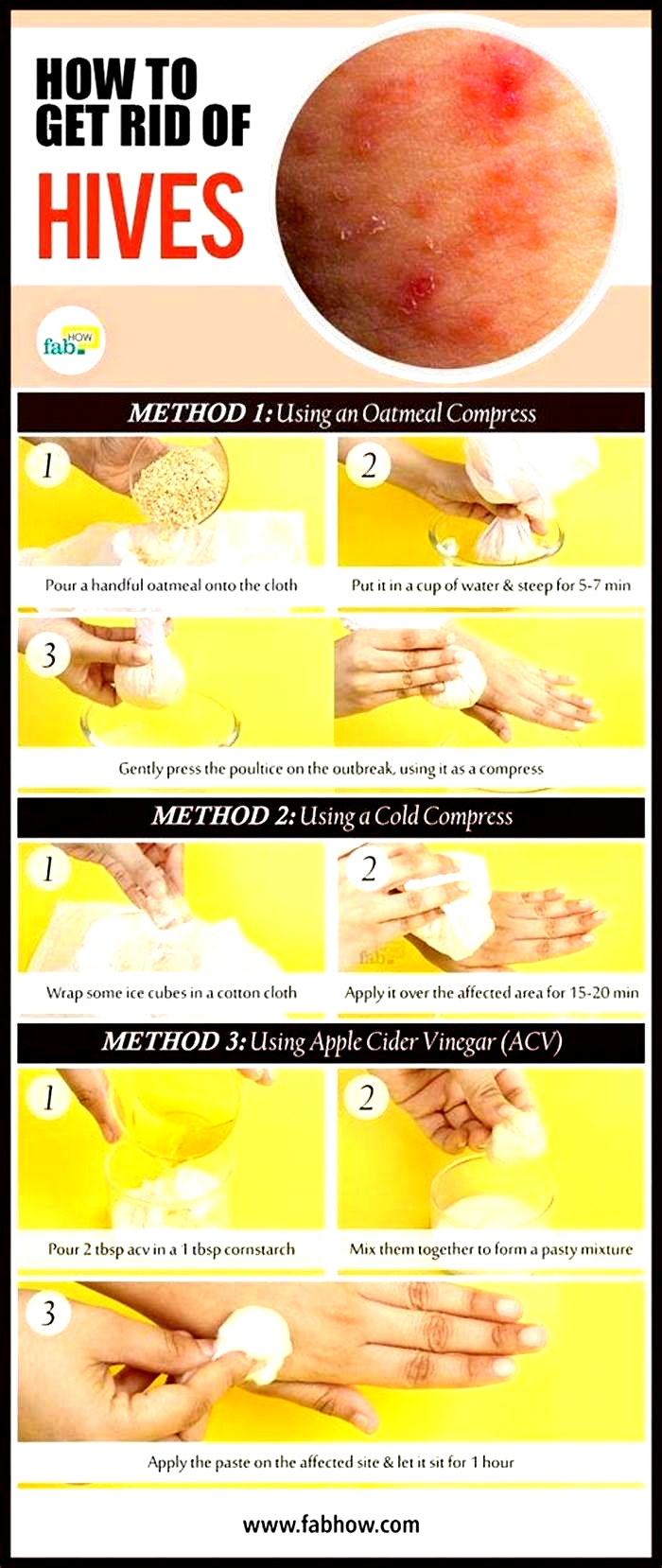 What is the fastest way to cure severe hives?