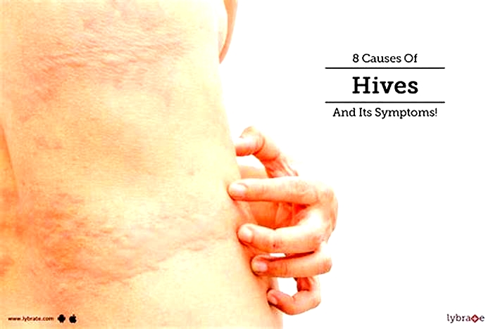 What makes hives worse?