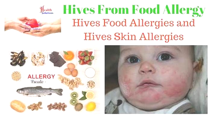 What should I eat if I have hives