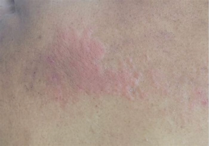 Why are hives worse at night?