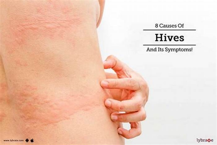 Why do I suddenly get hives?