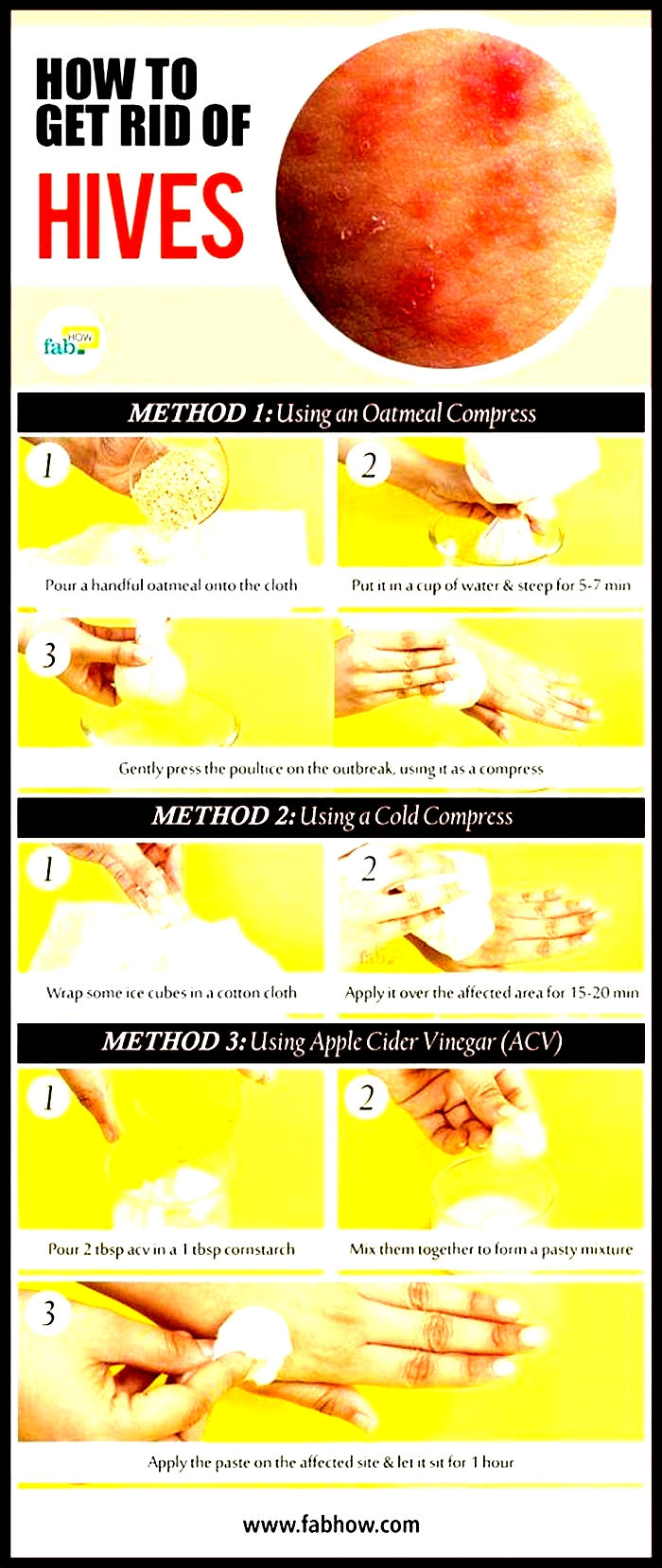 Will hives go away if I stop scratching?